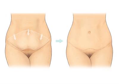 Abdominoplasty (tummy-tuck) – Isabella Karat